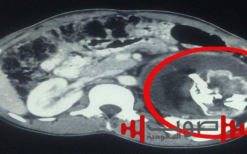 معجزة طبية.. استخراج «جنين طفيلي» من بطن رضيع