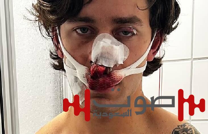 طعنات تشوه وجه عارض أزياء أمريكي أثناء دفاعه عن سيدتين