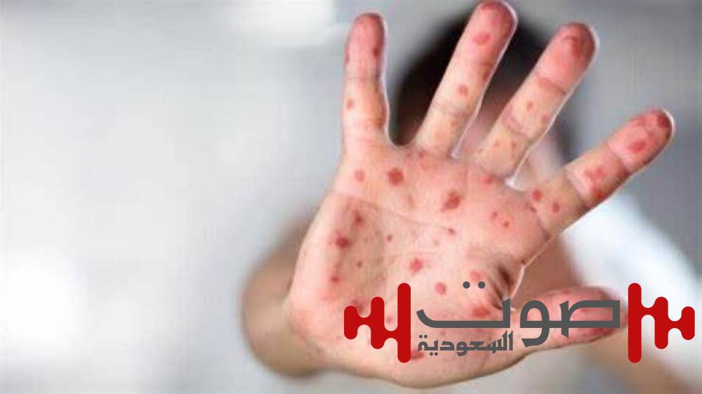 أزمة صحية في تكساس.. الحصبة تنتشر في دالاس وتثير الذعر بين السكان