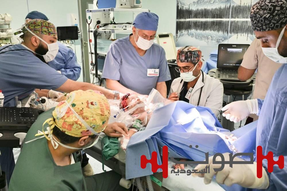 السعودية الأولى عالمياً في فصل التوائم السيامية