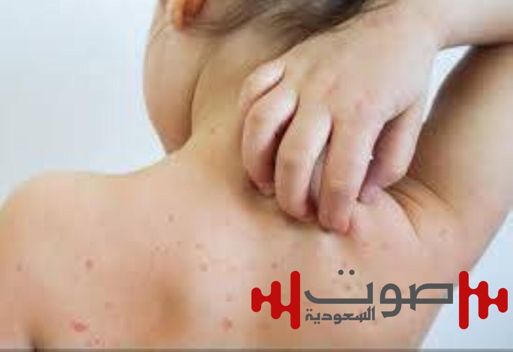 الحصبة تضرب بقوة.. 10 ولايات أمريكية تحت وطأة التفشي