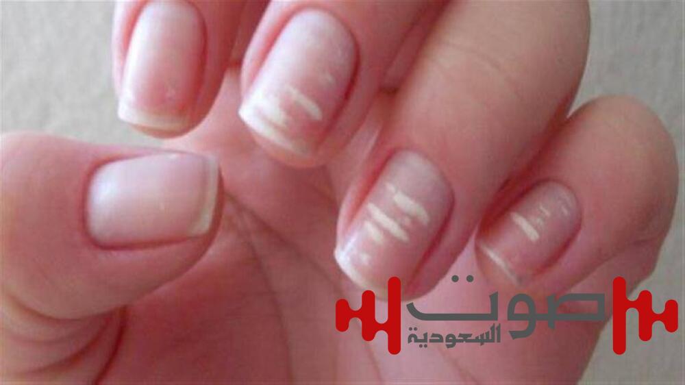 علامة بالأظافر تكشف إصابتك بسرطان نادر