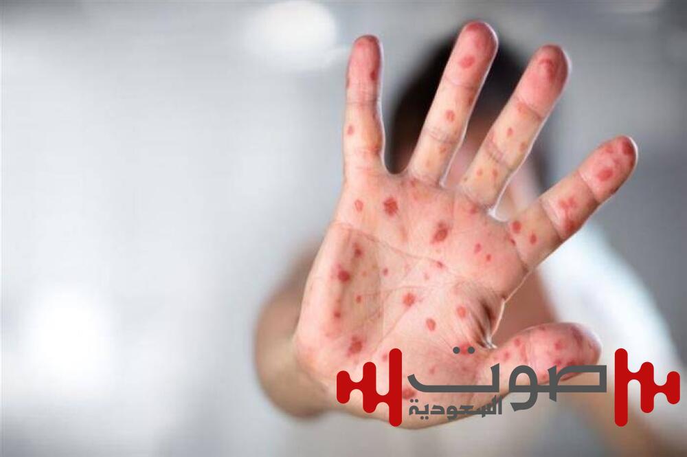 «الحصبة» تثير مخاوف الأمريكيين.. وتحركات واسعة للحد من المرض