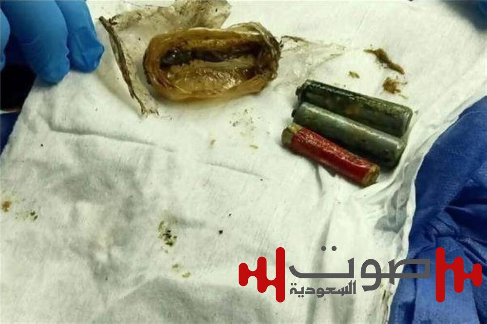 استخراج 3 بطاريات عالقة في معدة مريض لأكثر من عام ونصف