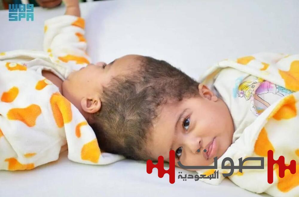 نجاح فصل التوأم الملتصق الإريتري «أسماء وسمية» بعد عملية استغرقت أكثر من 15 ساعة