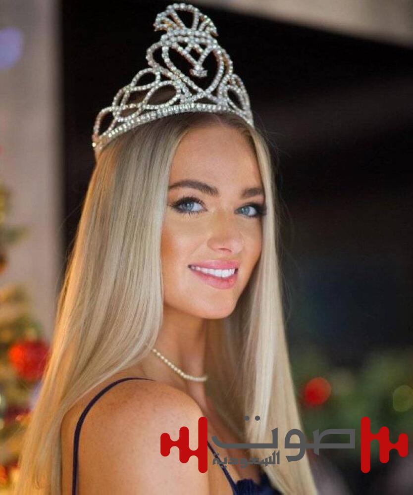 «عضّة» تجرد ملكة جمال أسكتلندا من لقبها!