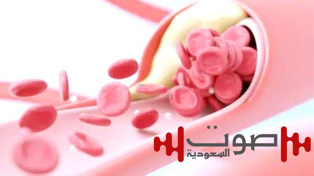 هل يحتاج المصابون بضيق في شرايين الرقبة لجراحة «السُباتي»؟