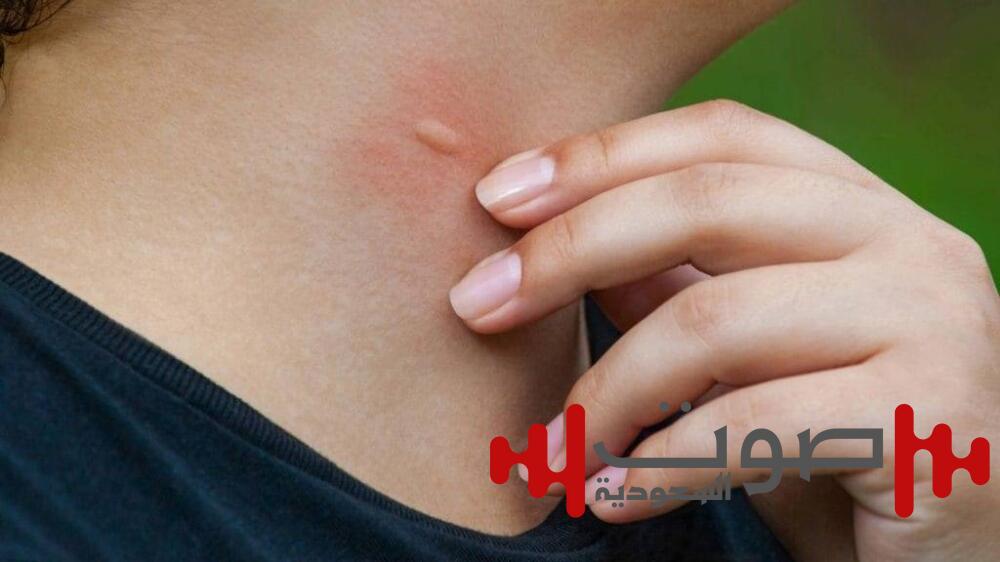 بعد التحذير العاجل للصحة العالمية.. هل تعود «الملاريا» لتهدد العالم؟