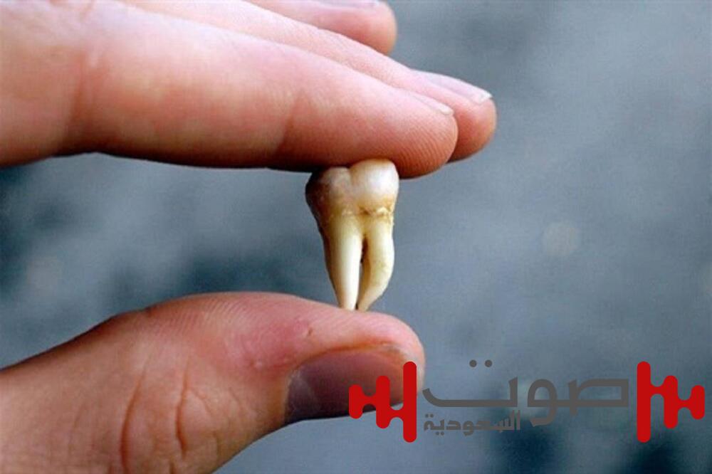 ما الحالات التي يجب فيها قلع أضراس العقل؟