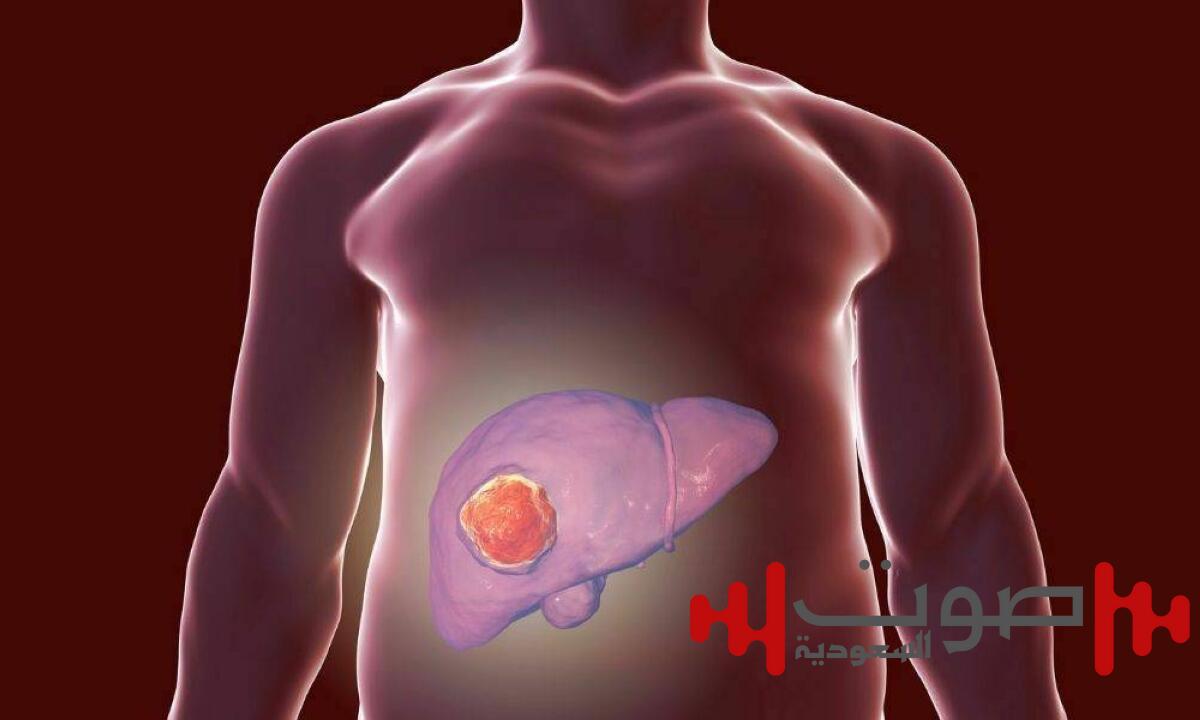 خبراء: تضاعف حالات سرطان الكبد بحلول 2050.. ما لم تُتخذ إجراءات عاجلة