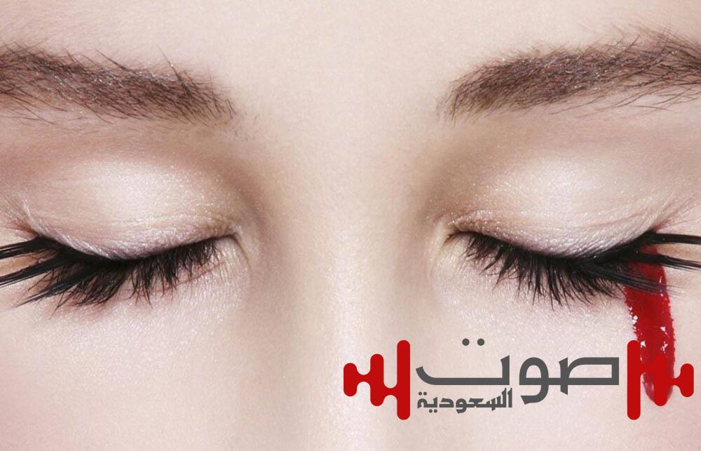 الصحة العالمية: احذروا «ماربورغ»