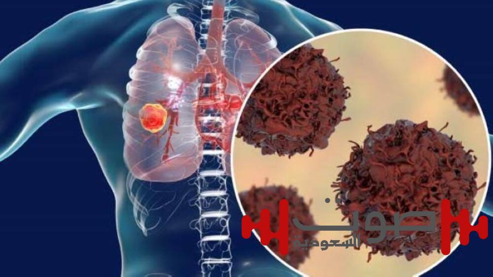 أمل جديد للملايين.. «الدواء الأمريكية» تُصادق على أول علاج مبتكر لسرطان الرئة