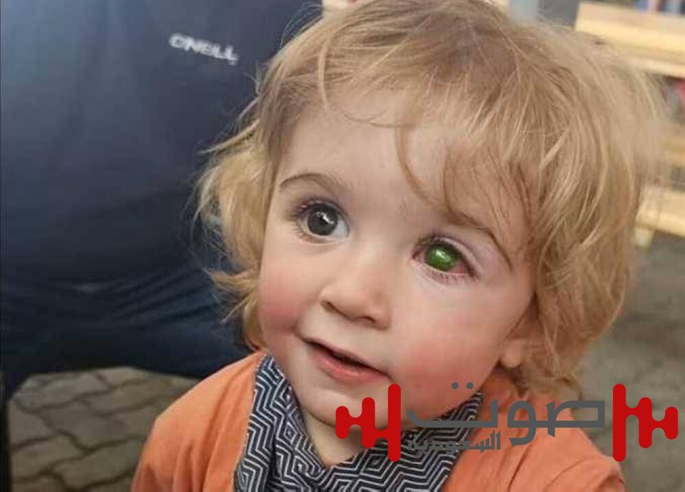 طفل بريطاني يفقد عينه بسبب قبلة.. احذروا من «الهربس»